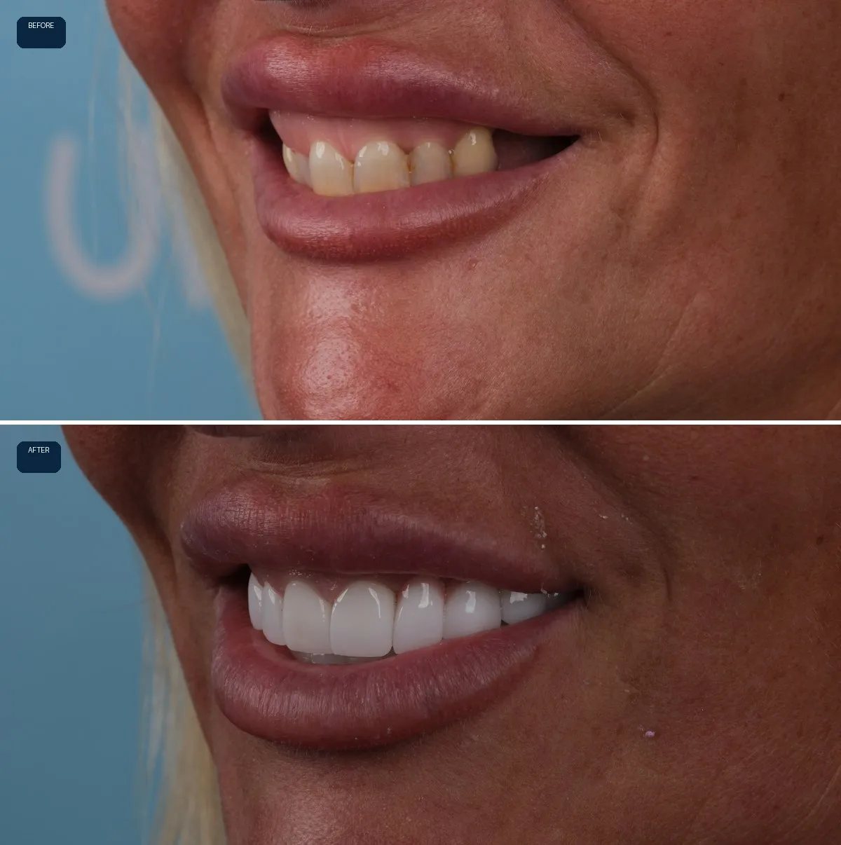 Close-up of Nicola's teeth before and after Dental Implants and Zirconia Crowns, view 2