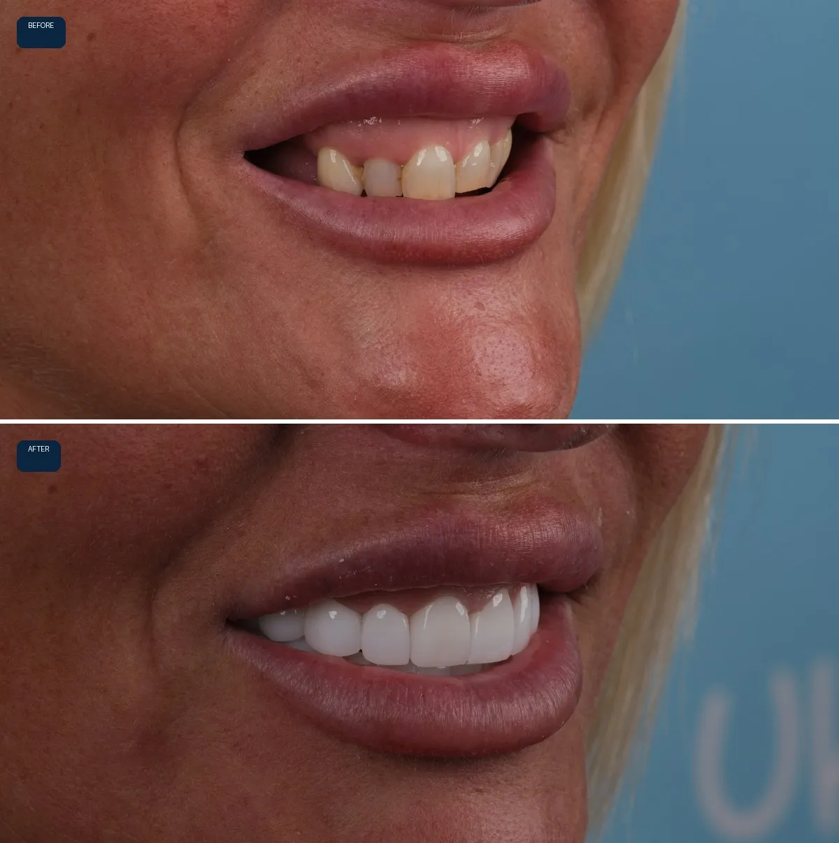 Close-up of Nicola's teeth before and after Dental Implants and Zirconia Crowns, view 3