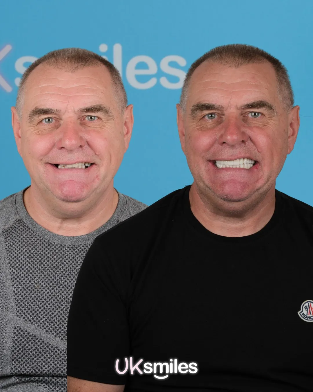 Older man in a black T-shirt before and after a full set of new teeth