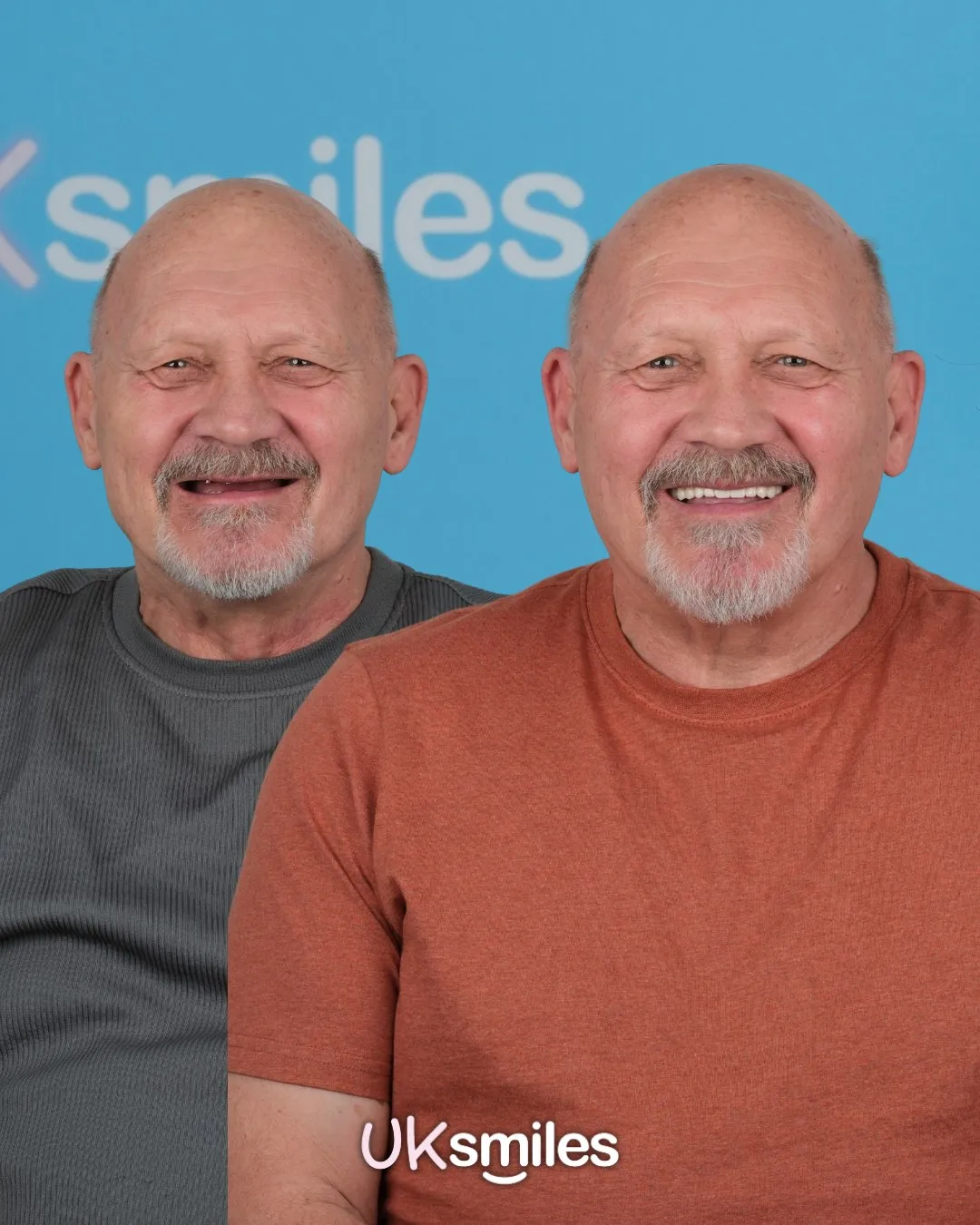 Older man with a grey beard before and after his new smile in Antalya