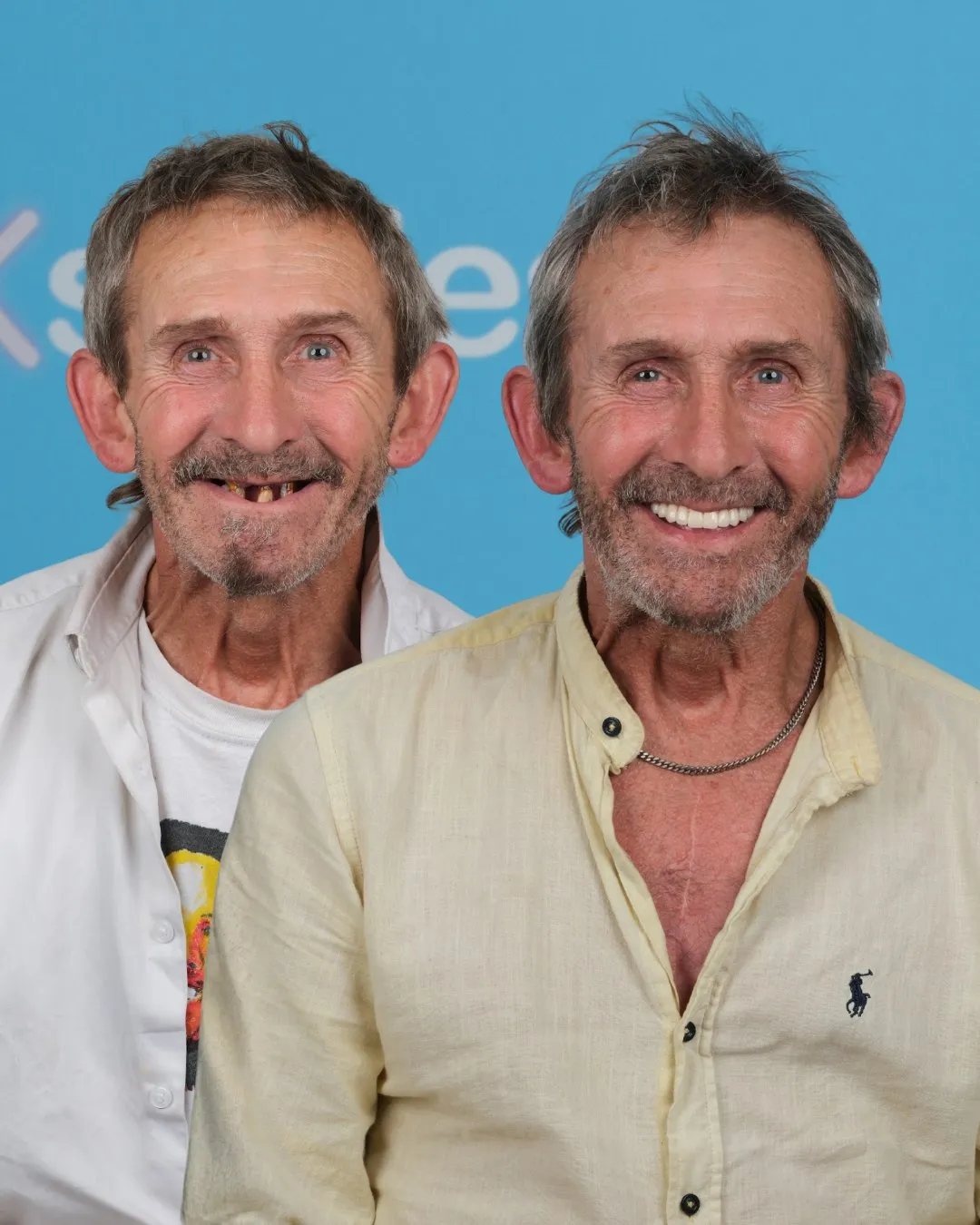 Older man with missing front teeth before and a complete new smile after treatment
