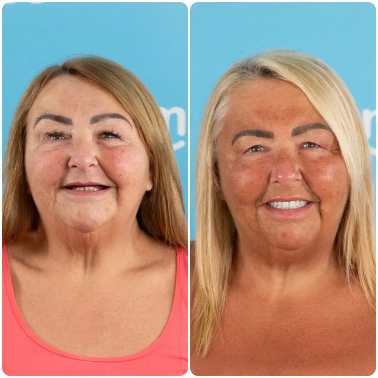 Before and after dental crowns on an older UK Smiles patient treated in Turkey