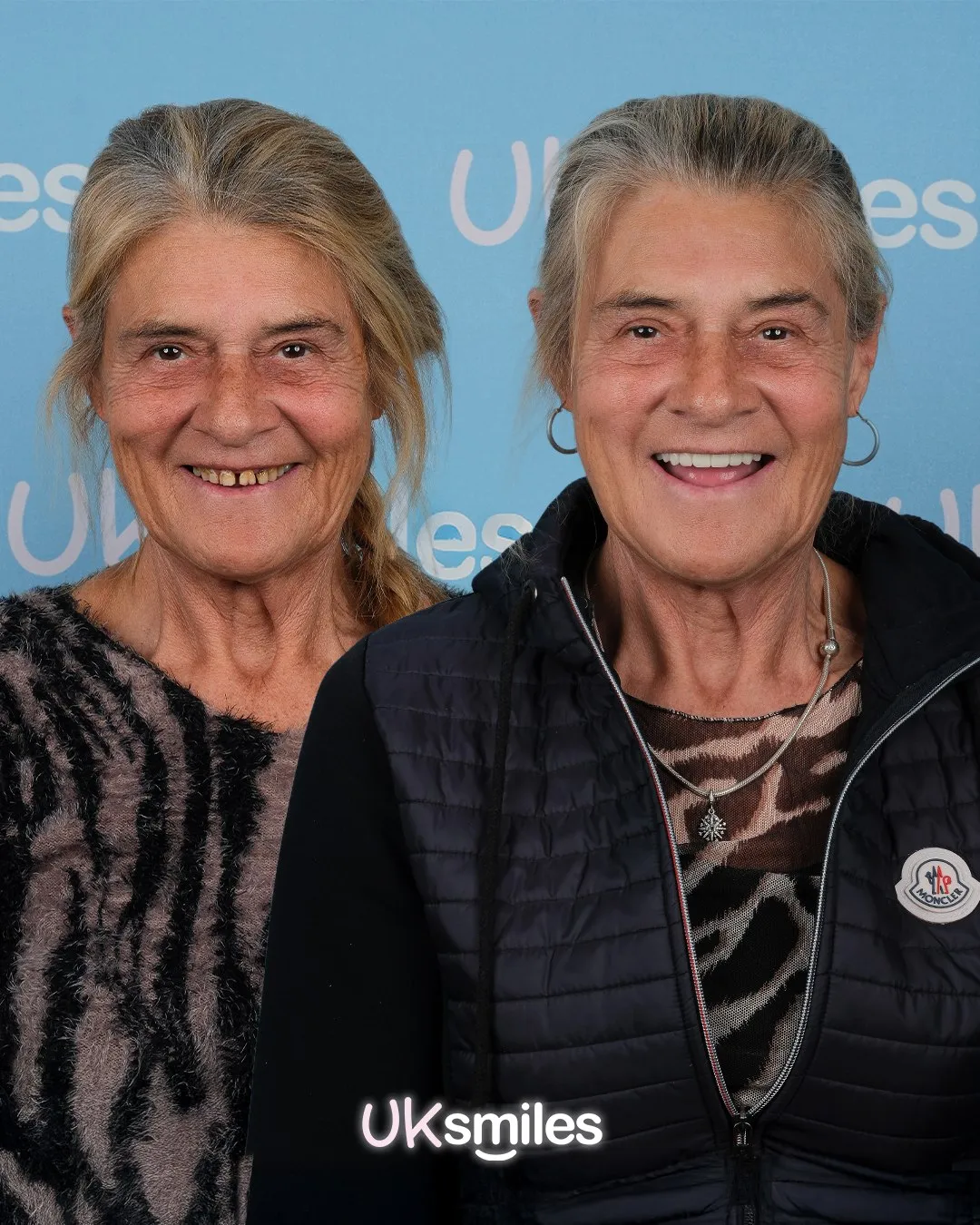 Older woman with few remaining teeth before and a full restored smile after treatment in Turkey