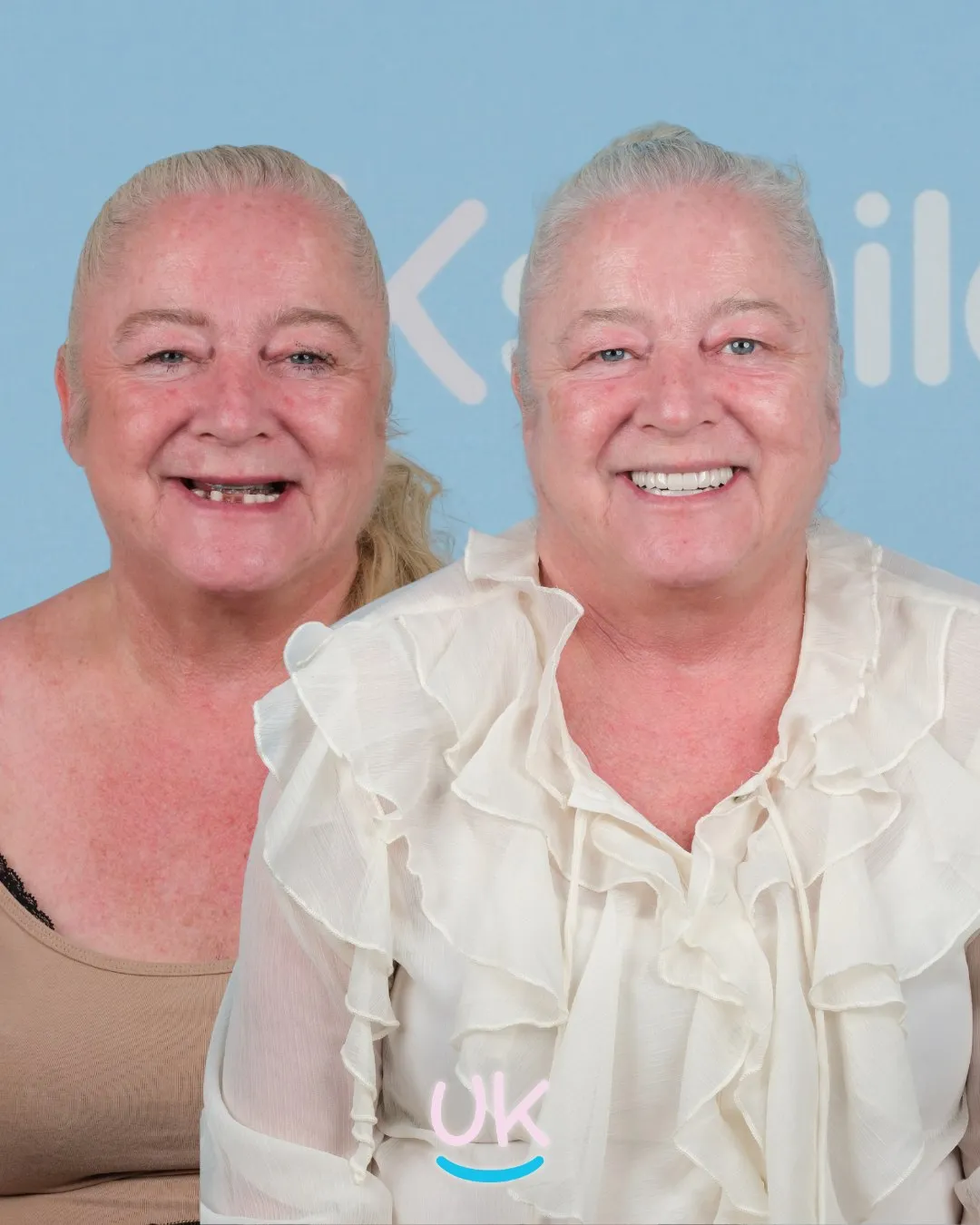 Older woman with missing teeth before and a full new smile after treatment in Turkey