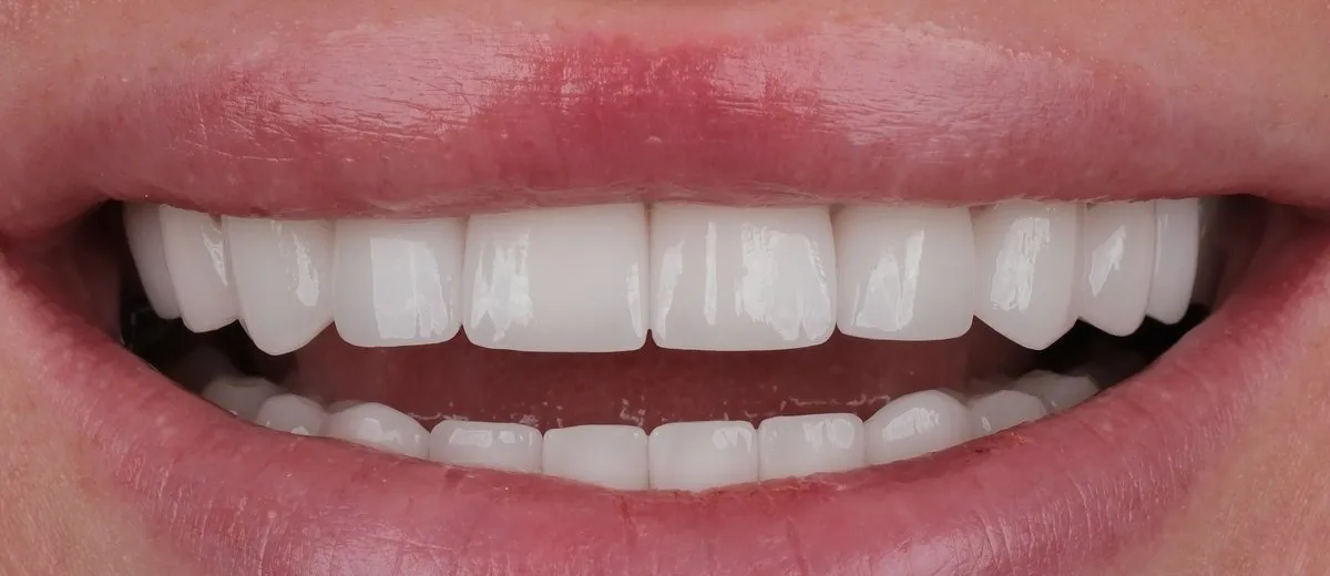A UK Smiles patient's smile after treatment: BL2 shade, Softened style