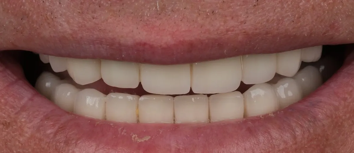 A UK Smiles patient's smile after treatment: A1 shade, Natural style