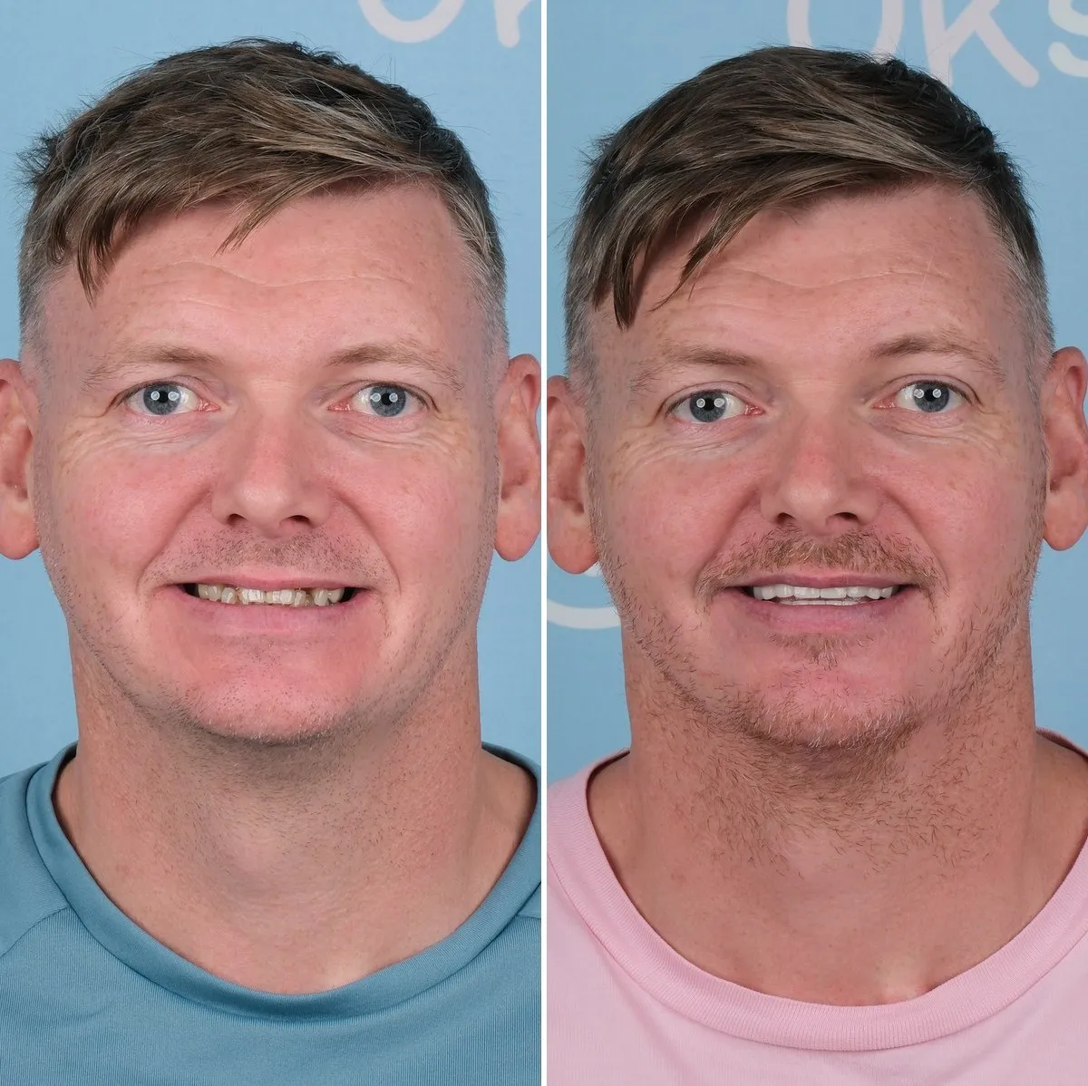 Ryan before and after full smile makeover with UK Smiles