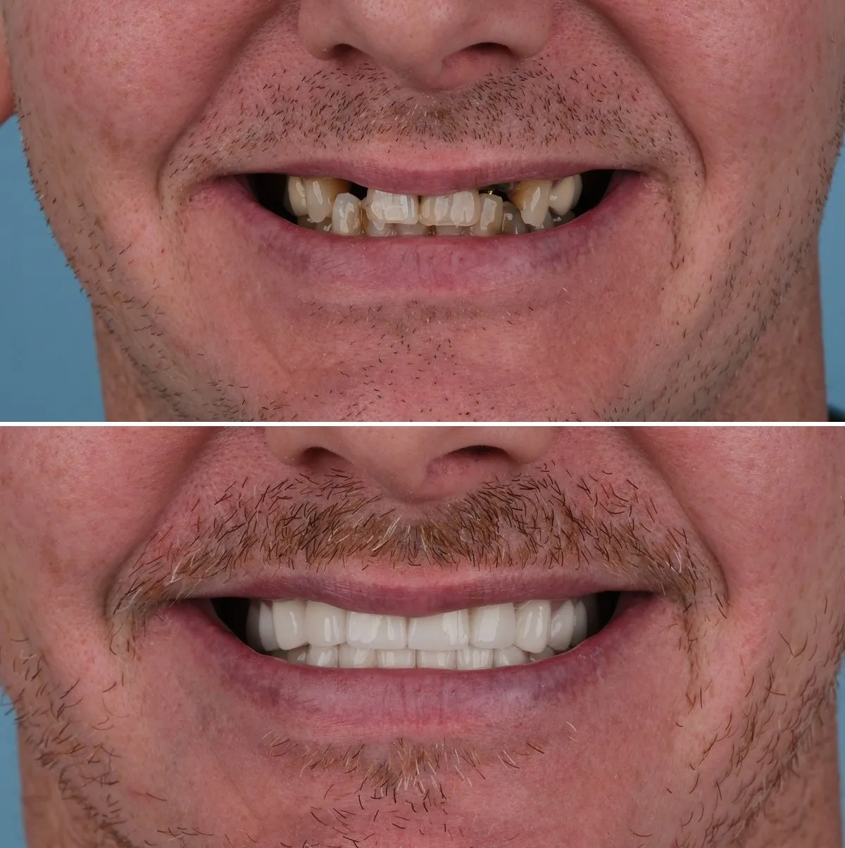 Close-up of Ryan's teeth before and after Full Smile Makeover, view 1