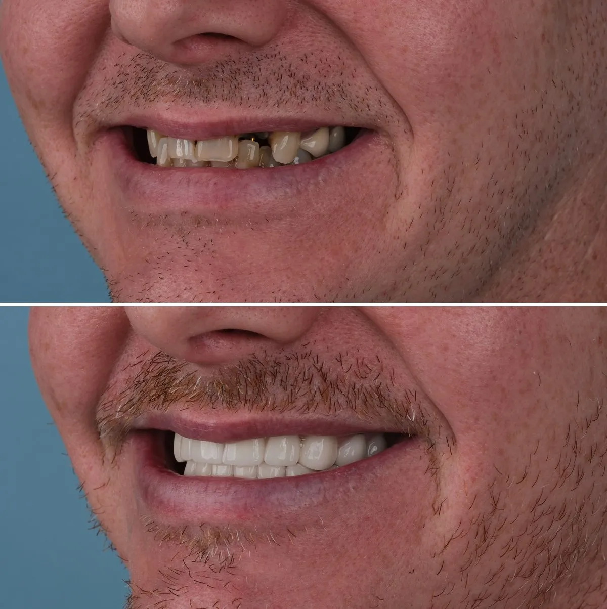 Close-up of Ryan's teeth before and after Full Smile Makeover, view 2