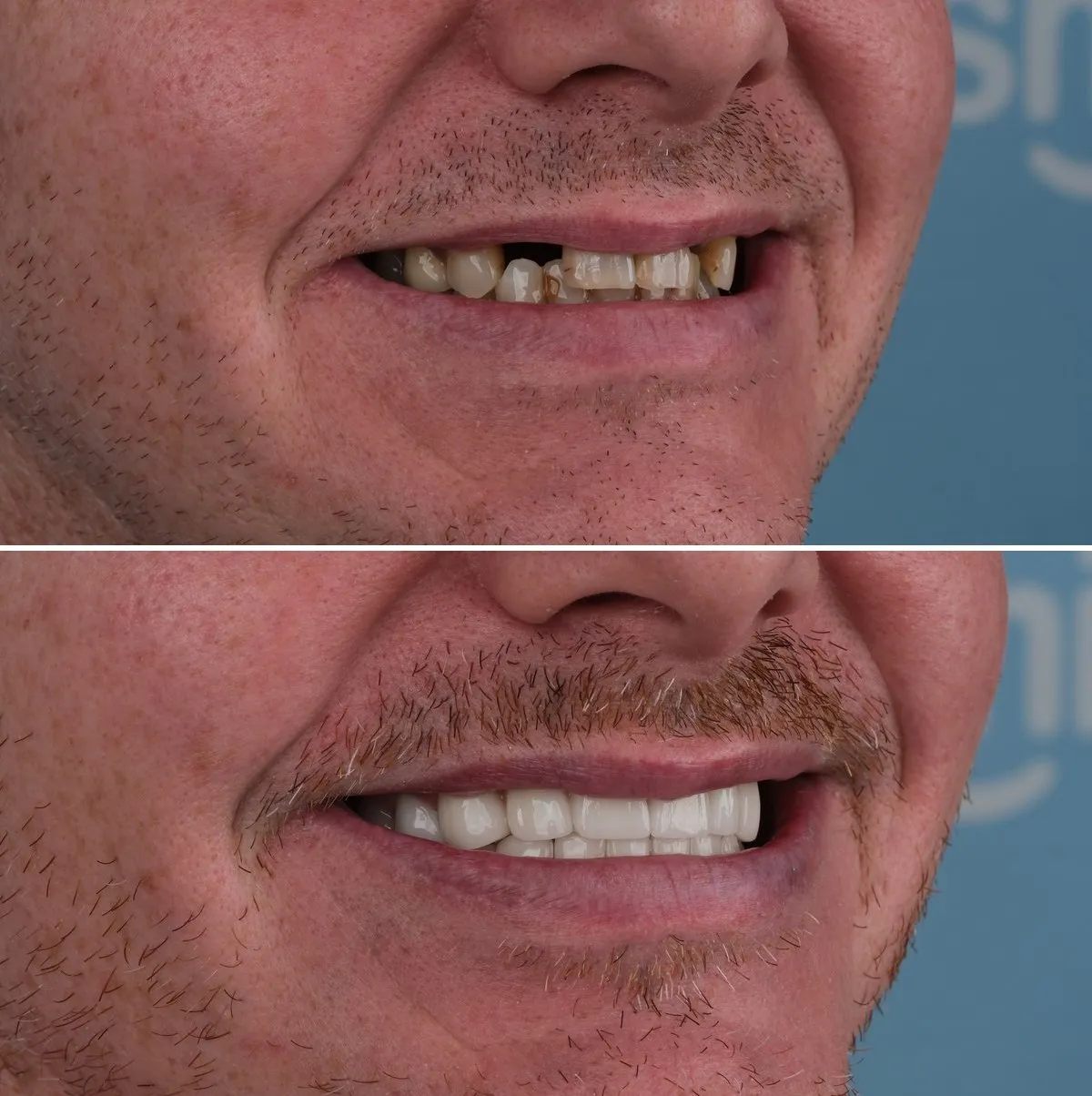 Close-up of Ryan's teeth before and after Full Smile Makeover, view 3