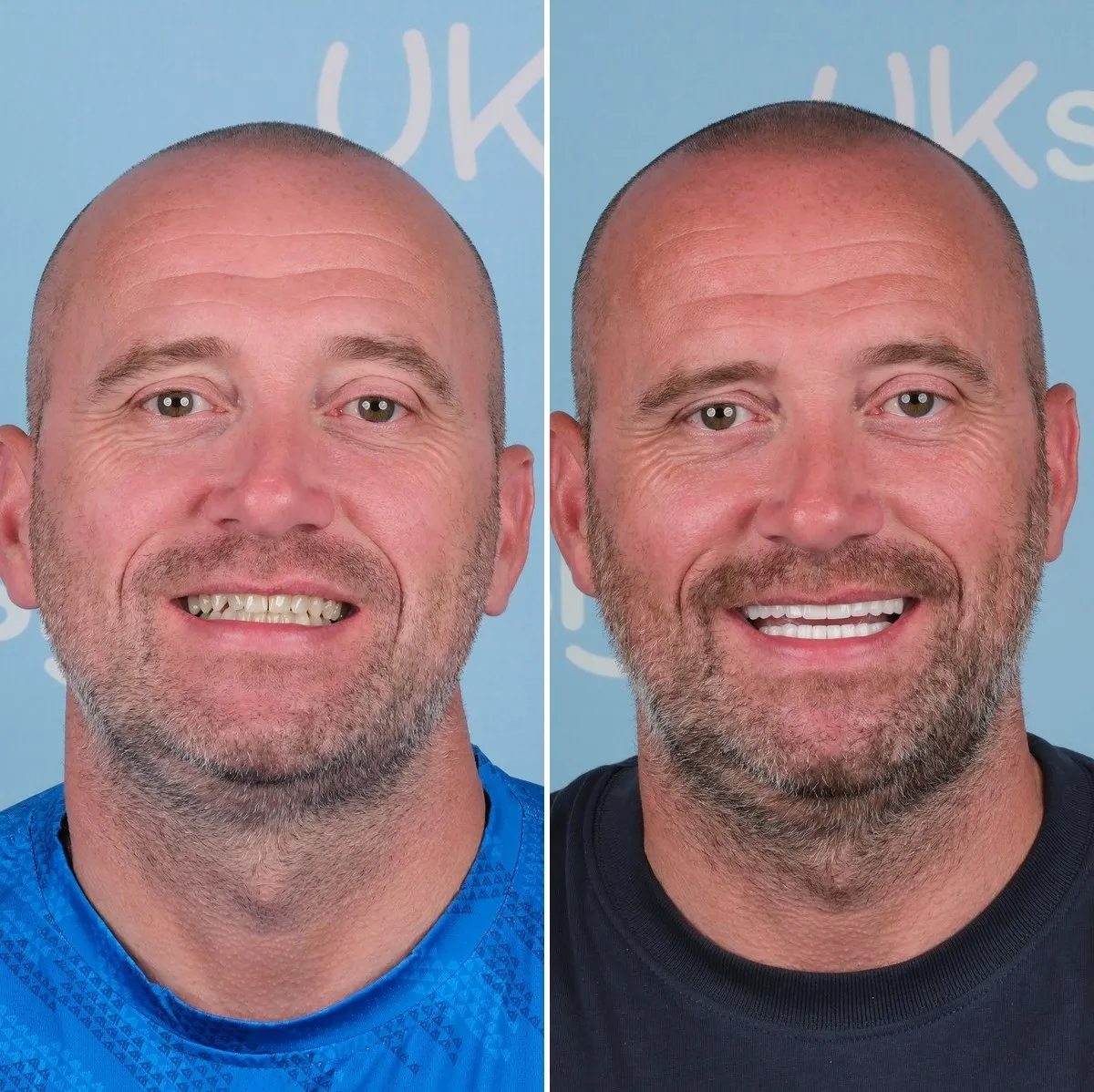 Scott before and after implants and crowns with UK Smiles