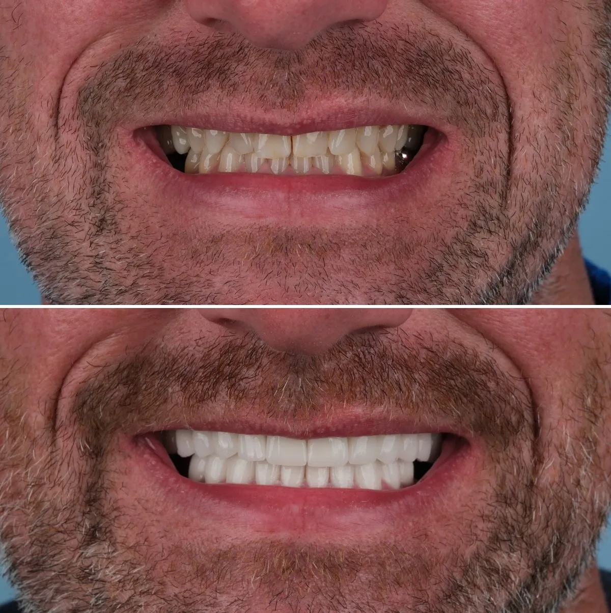 Close-up of Scott's teeth before and after Implants and Crowns, view 1