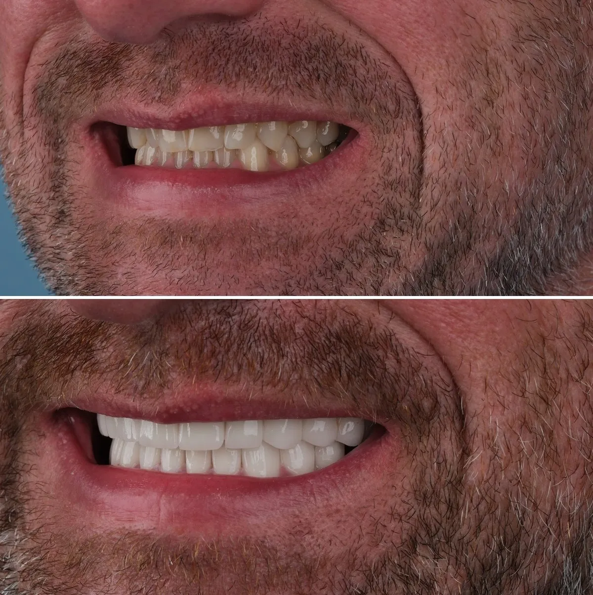 Close-up of Scott's teeth before and after Implants and Crowns, view 2