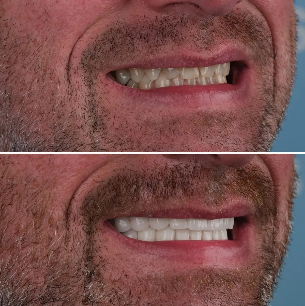 Close-up of Scott's teeth before and after Implants and Crowns, view 3