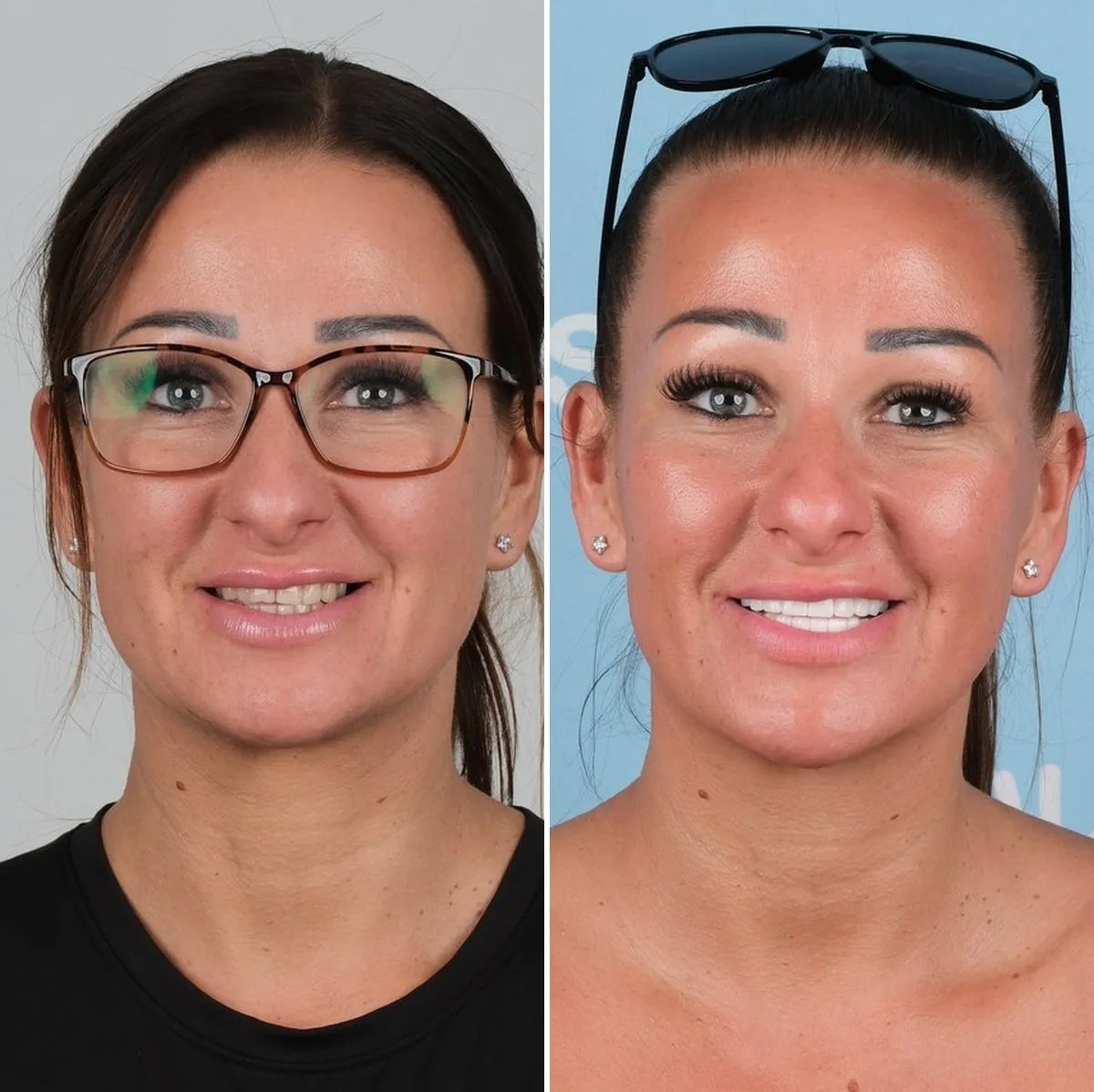 Sian before and after zirconia crowns with UK Smiles