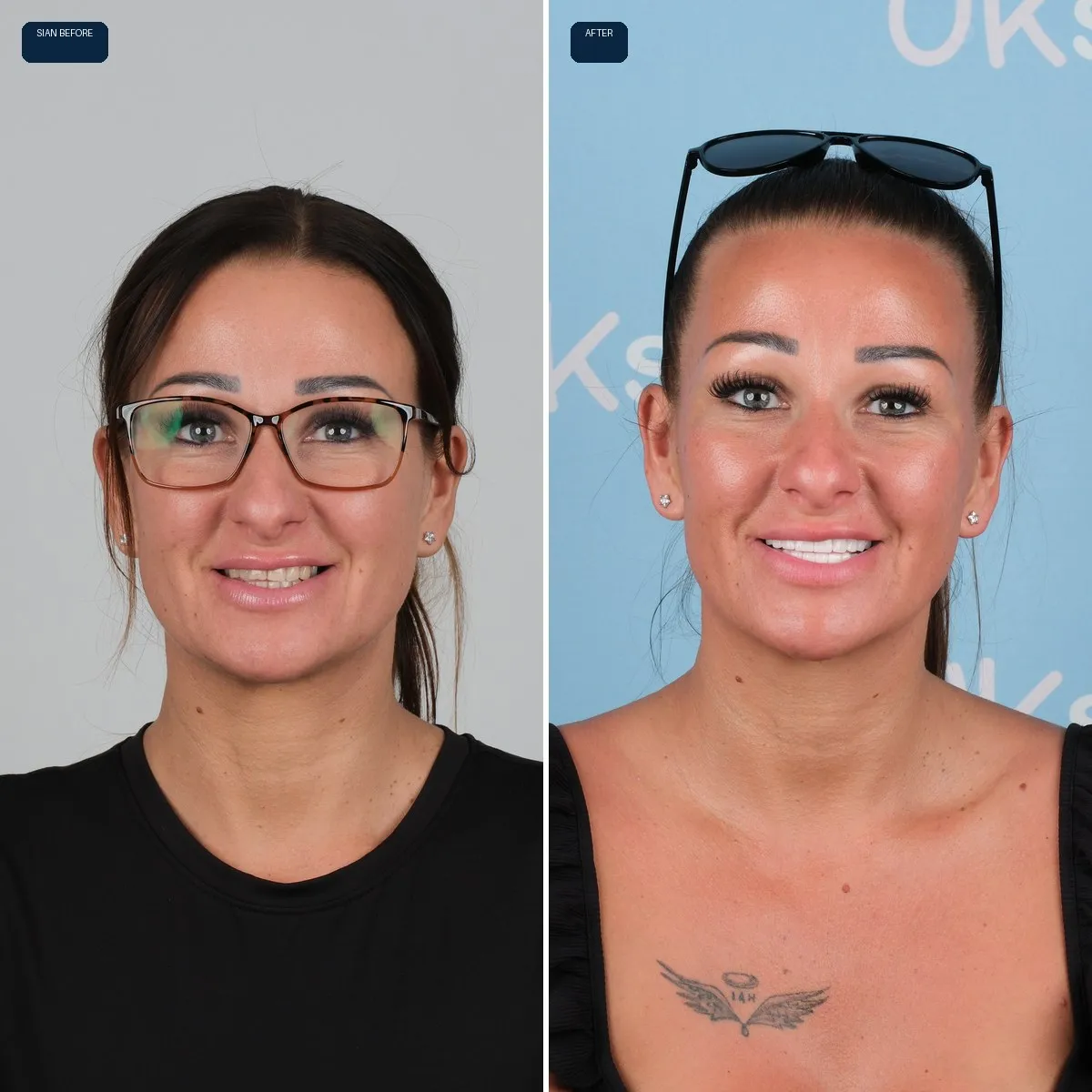 Sian and Christopher's face before and after Zirconia Crowns at UK Smiles in Antalya