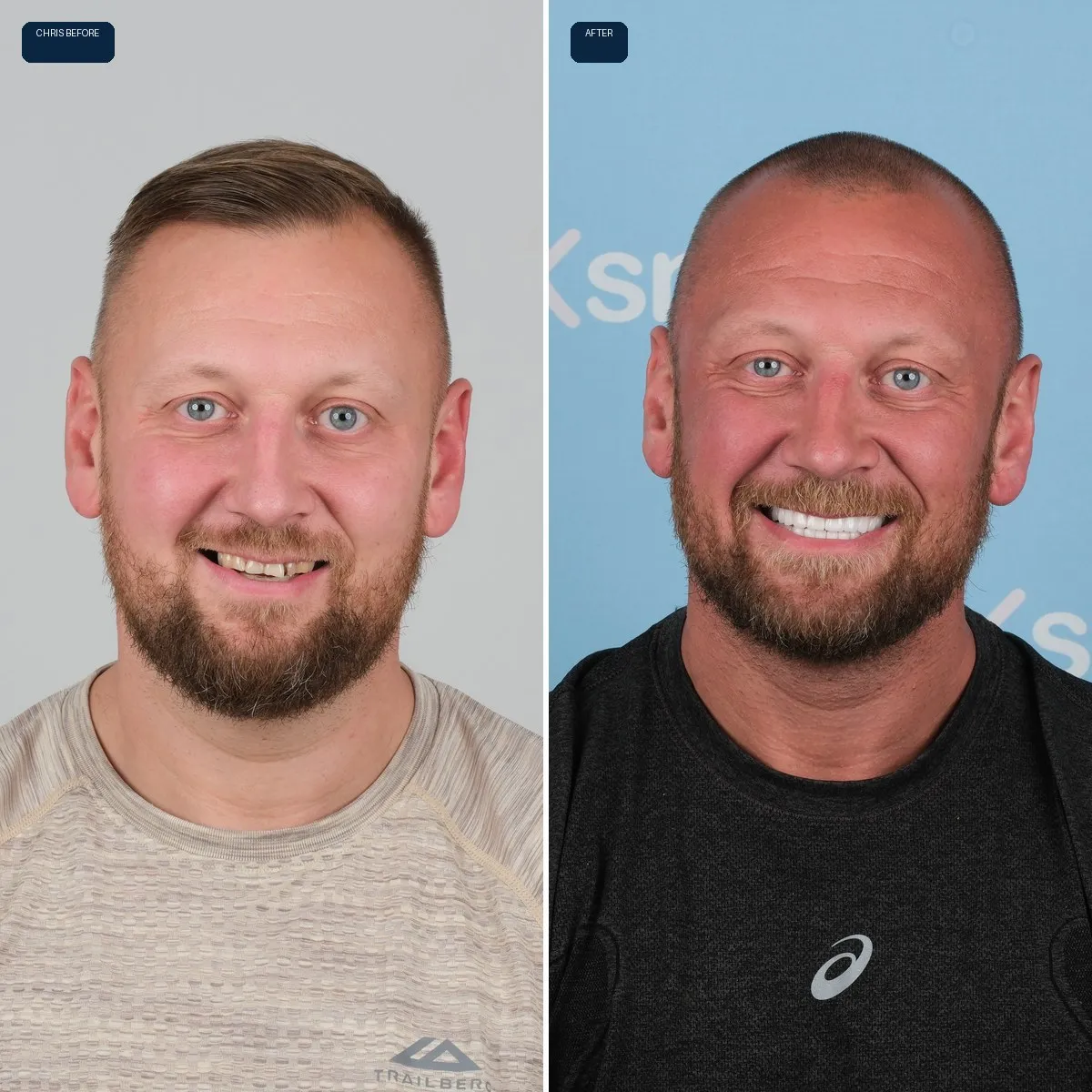 Close-up of Sian and Christopher's teeth before and after Zirconia Crowns, view 1