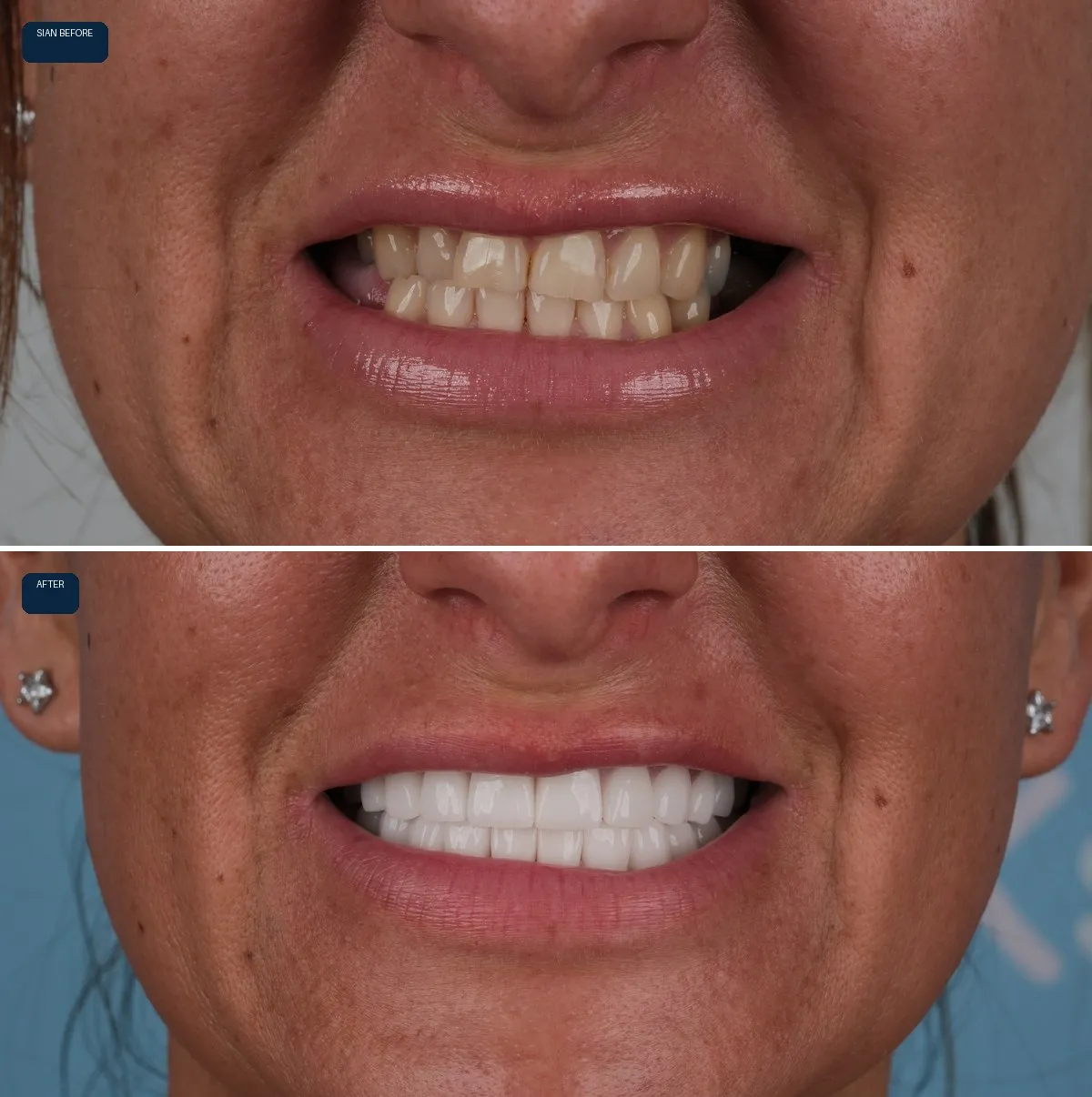 Close-up of Sian and Christopher's teeth before and after Zirconia Crowns, view 2