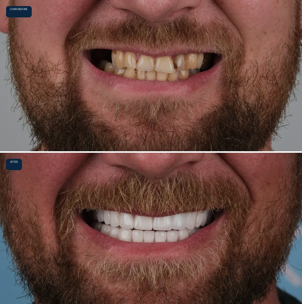 Close-up of Sian and Christopher's teeth before and after Zirconia Crowns, view 3