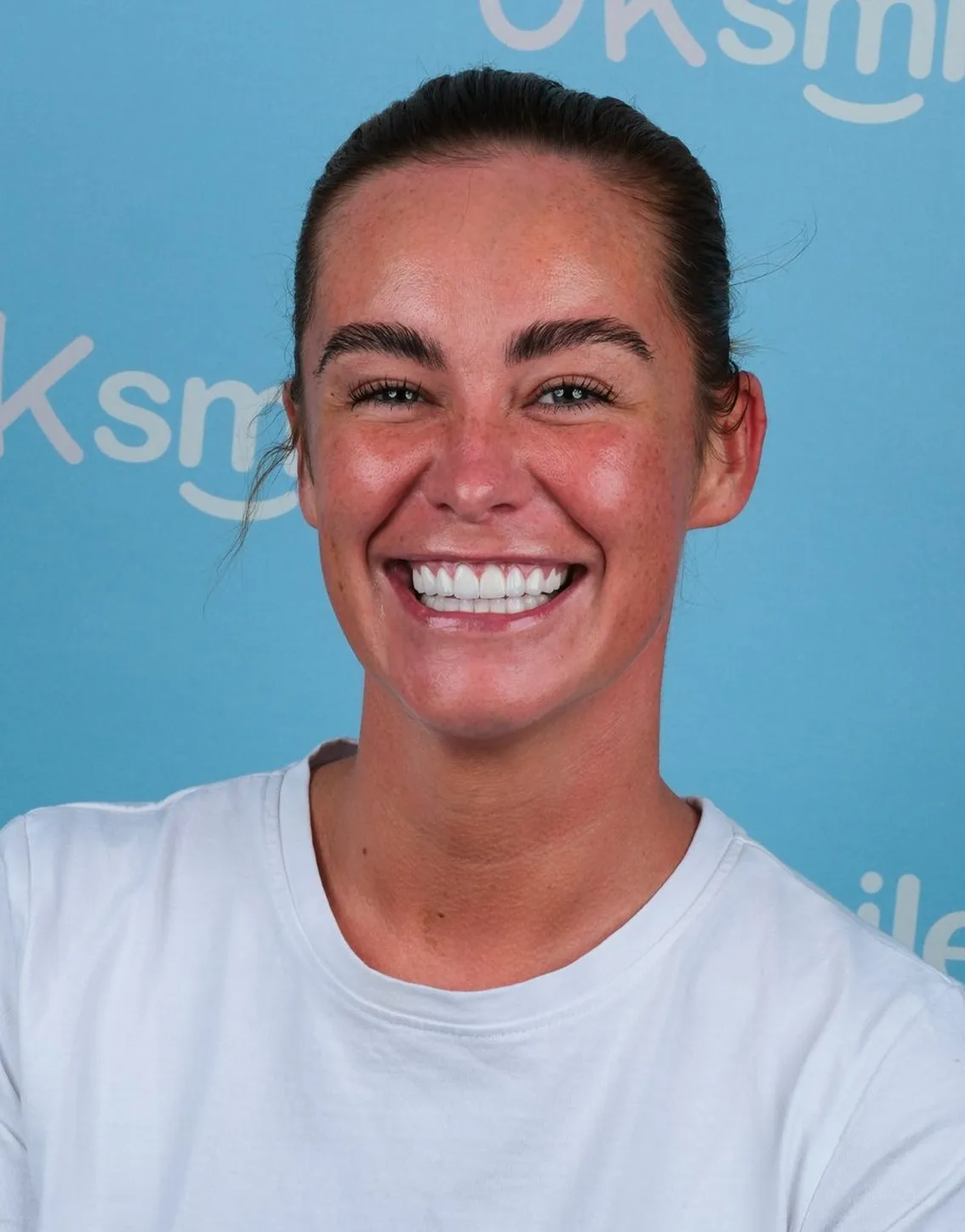 Ellie, Zirconia Crowns patient at UK Smiles in Antalya