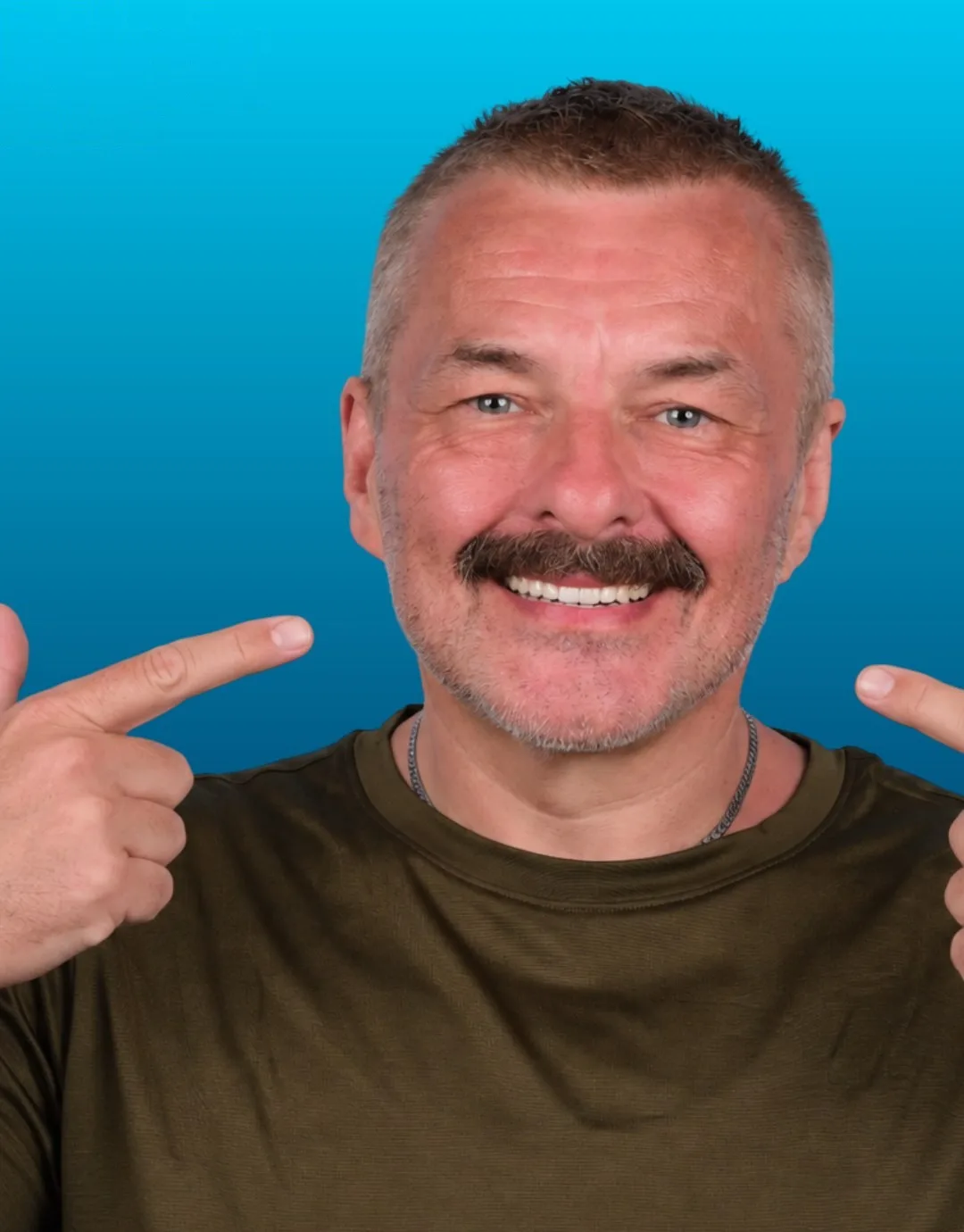 Nick, UK Smiles patient, after all-on-6 in Antalya