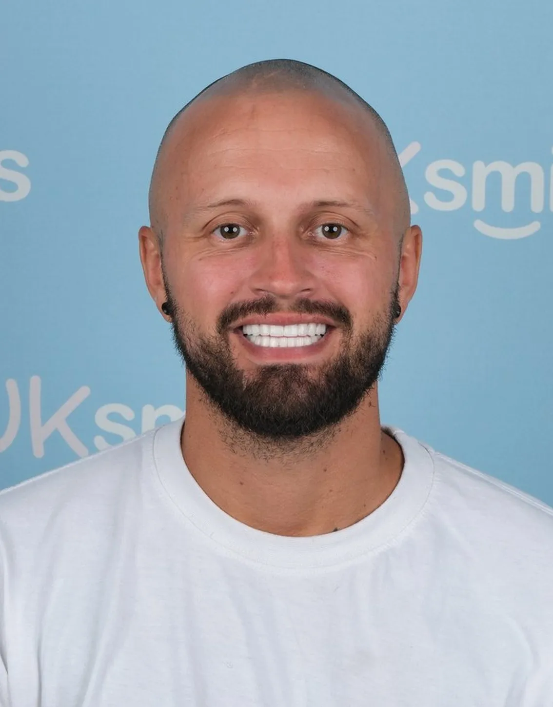Stuart, Zirconia Crowns patient at UK Smiles in Antalya