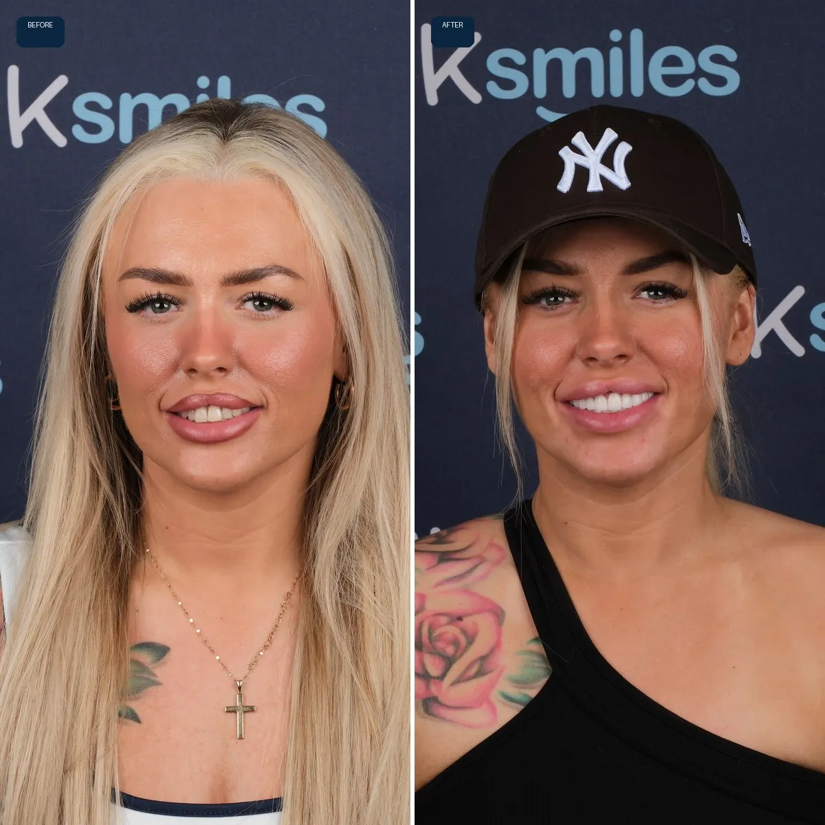 Stacey's face before and after Emax Veneers at UK Smiles in Antalya