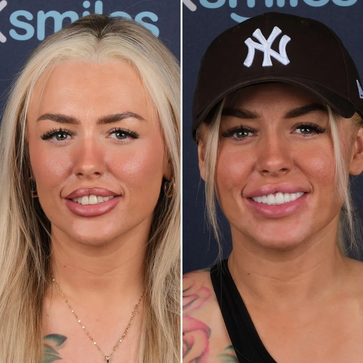 Stacey before and after emax veneers with UK Smiles