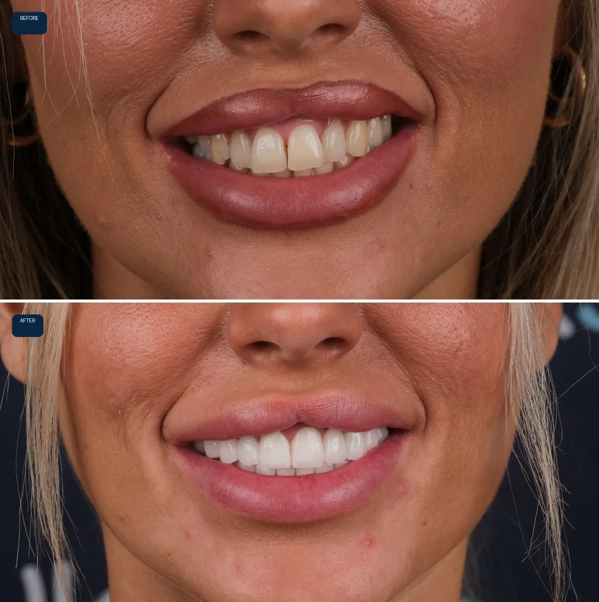 Close-up of Stacey's teeth before and after Emax Veneers, view 1