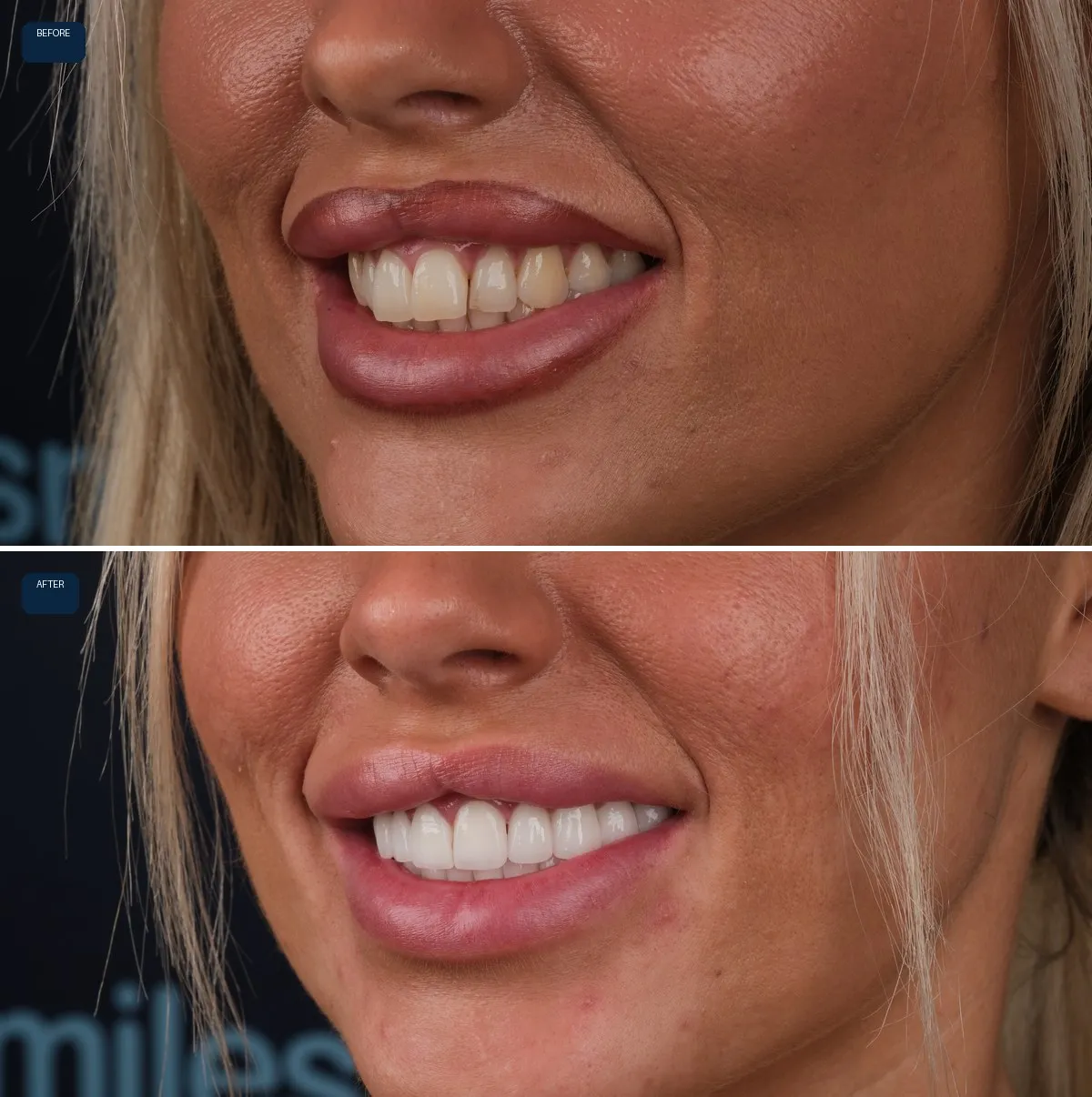 Close-up of Stacey's teeth before and after Emax Veneers, view 2