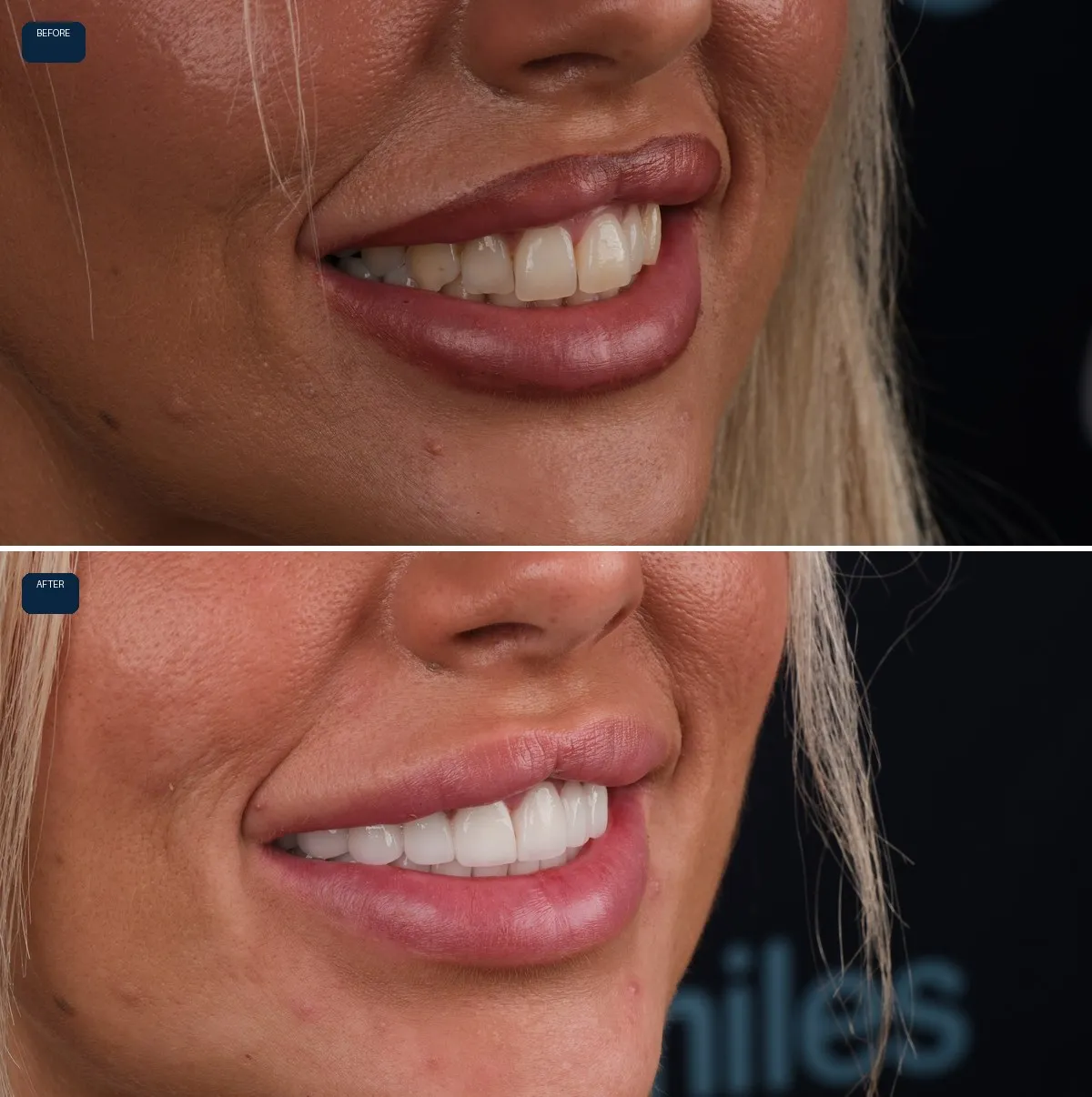 Close-up of Stacey's teeth before and after Emax Veneers, view 3