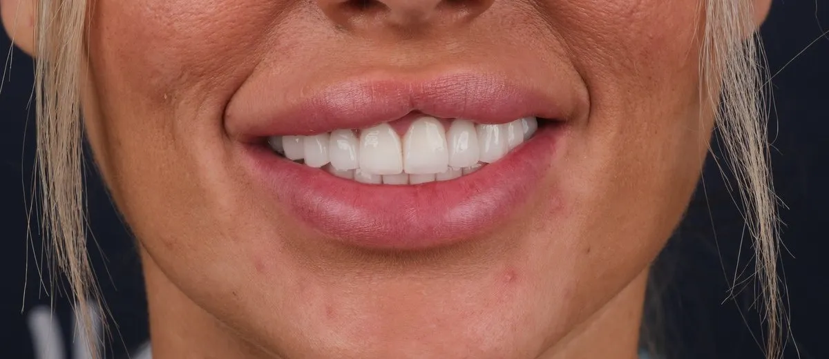 Stacey after Emax with UK Smiles