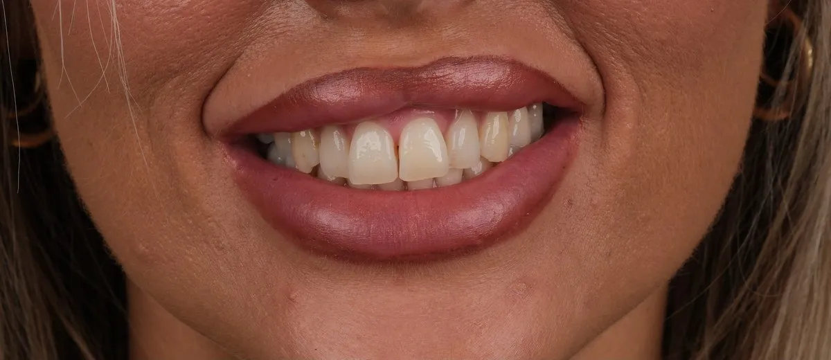 Stacey before Emax with UK Smiles