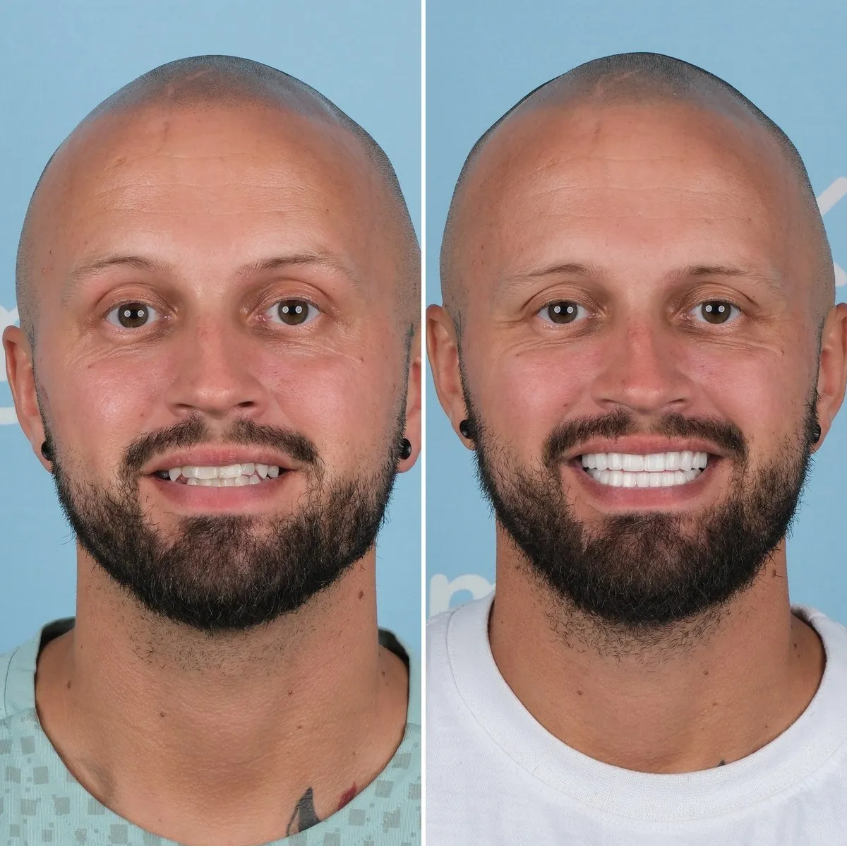 Stuart before and after zirconia crowns with UK Smiles