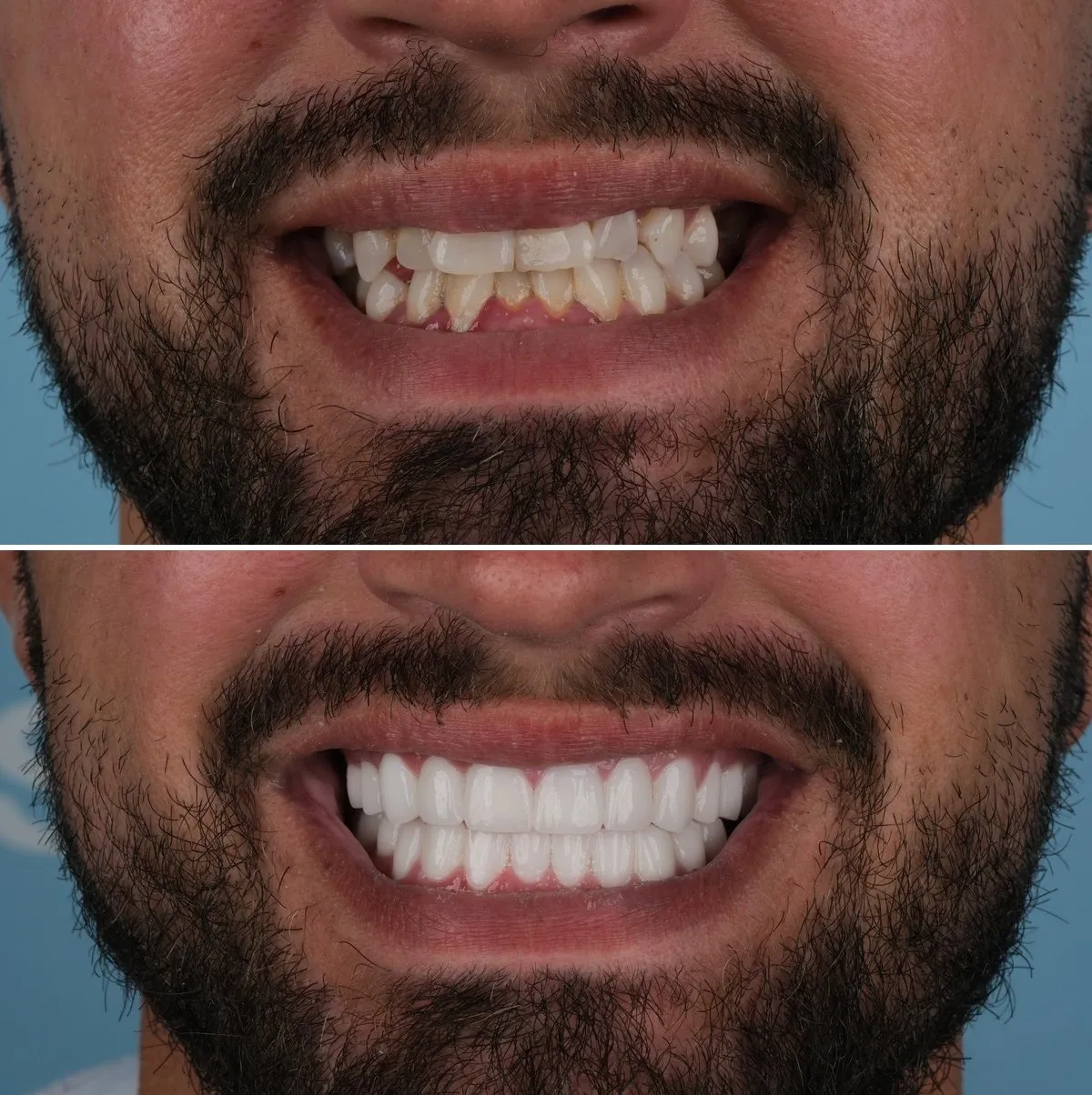 Close-up of Stuart's teeth before and after Zirconia Crowns, view 1