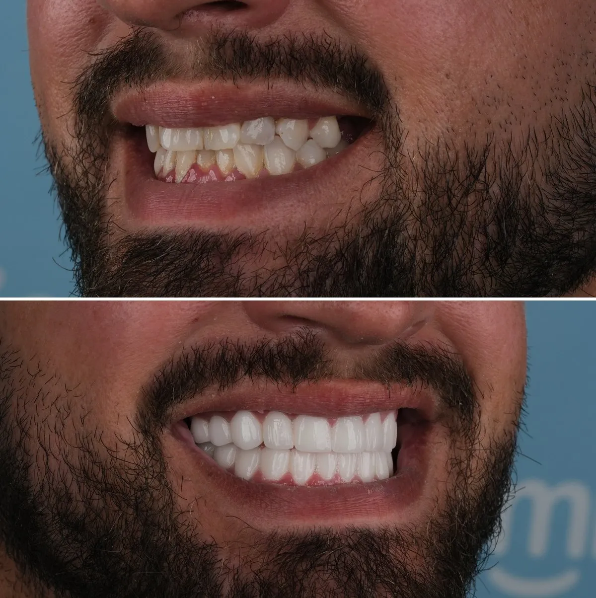 Close-up of Stuart's teeth before and after Zirconia Crowns, view 2