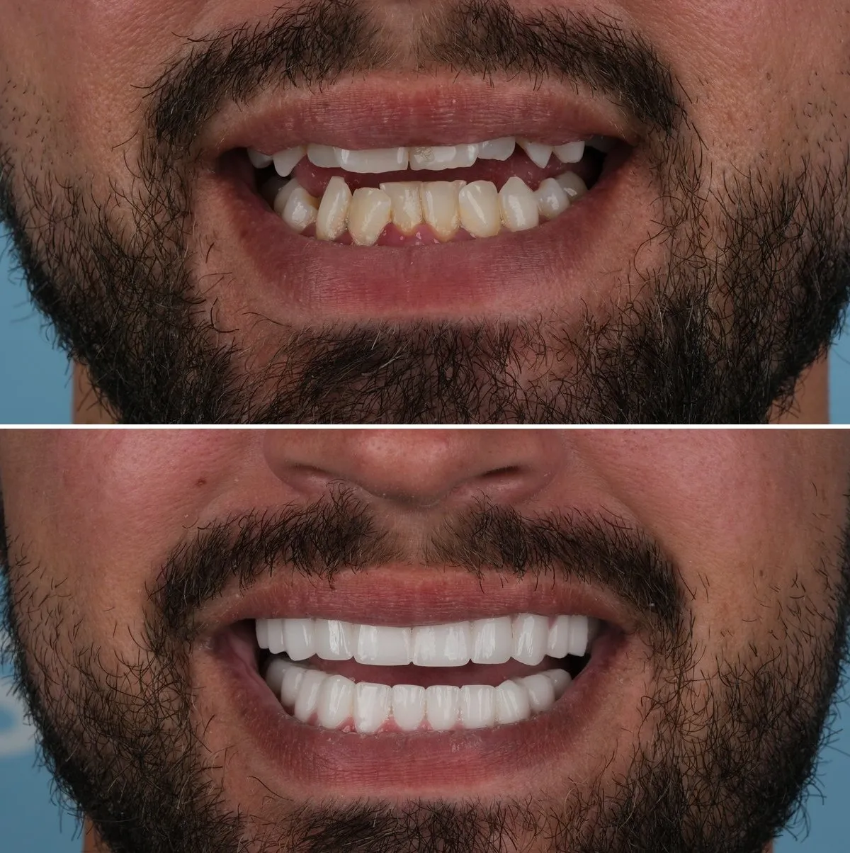 Close-up of Stuart's teeth before and after Zirconia Crowns, view 3
