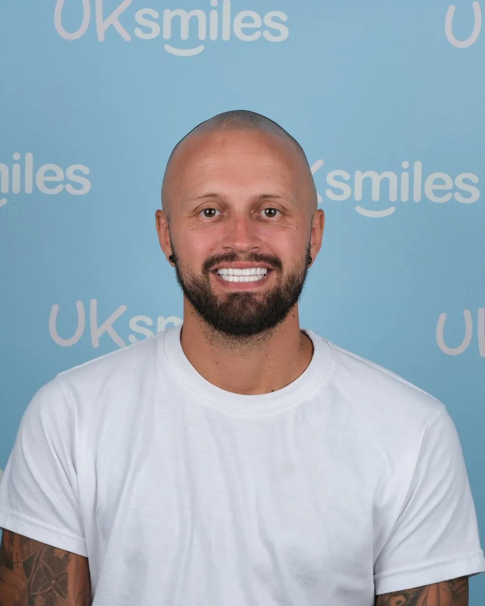 Stuart after Zirconia Crowns with UK Smiles in Antalya