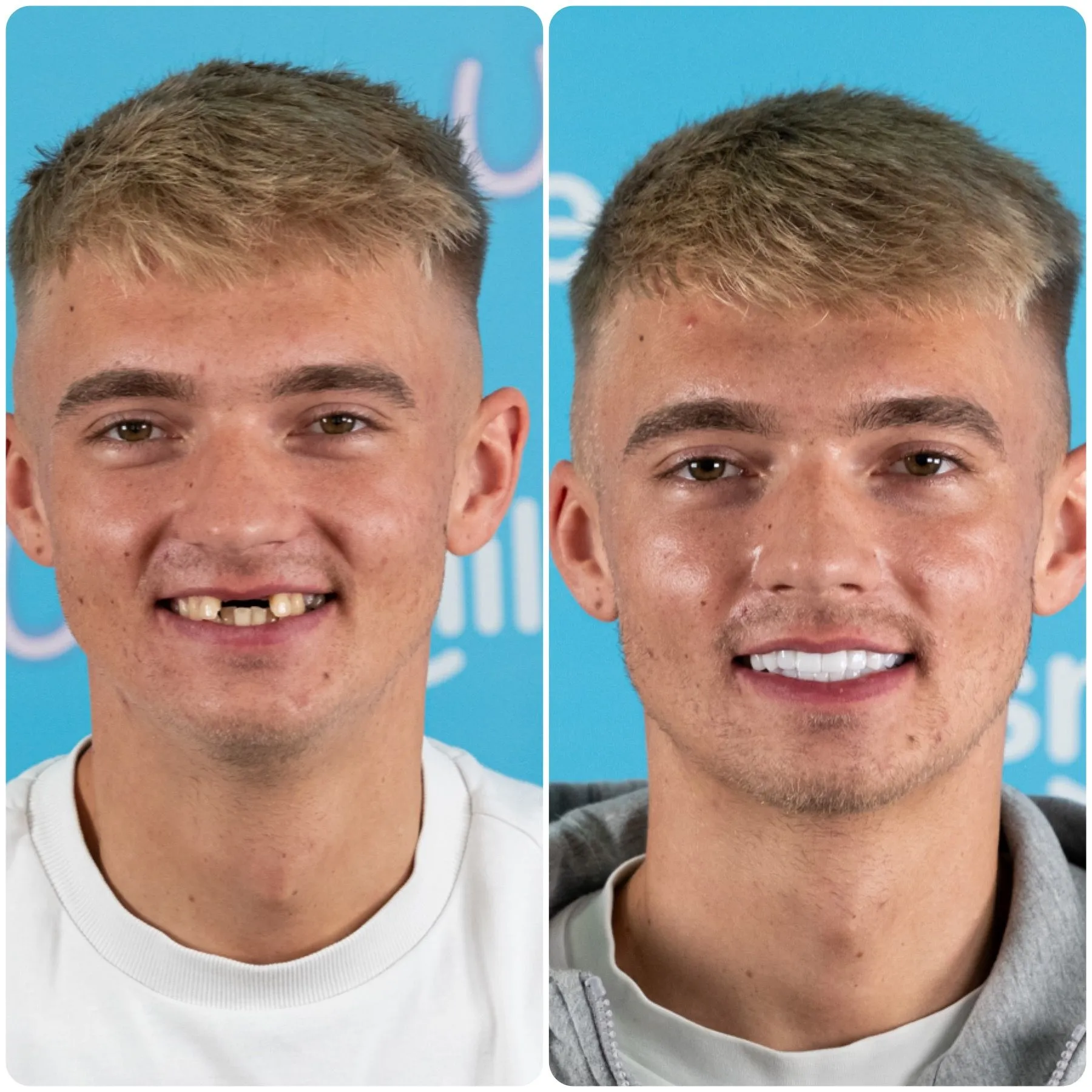 Young man with a missing front tooth before and a full white smile after