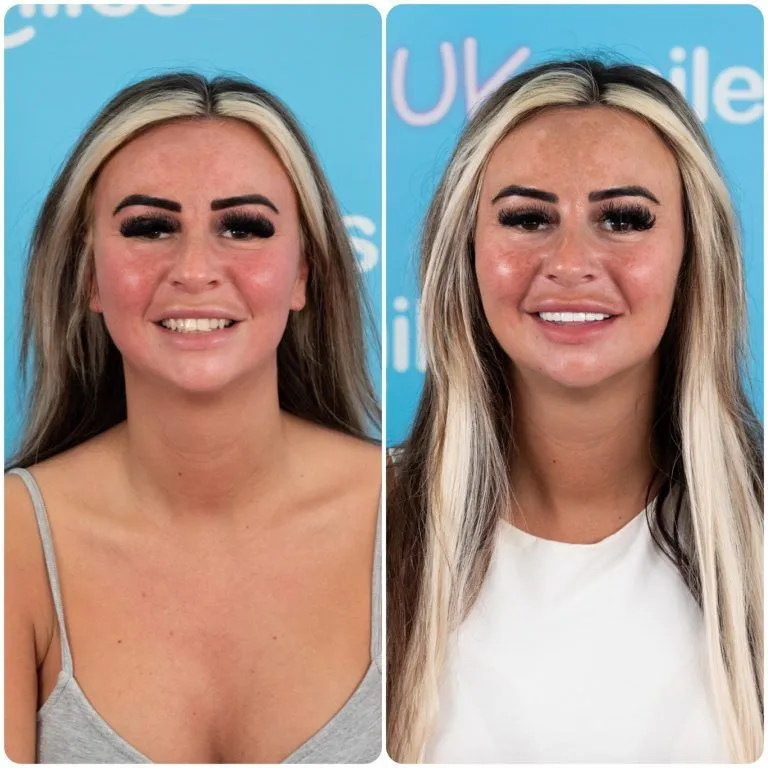 Blonde woman smiling before and after her new teeth at UK Smiles in Antalya