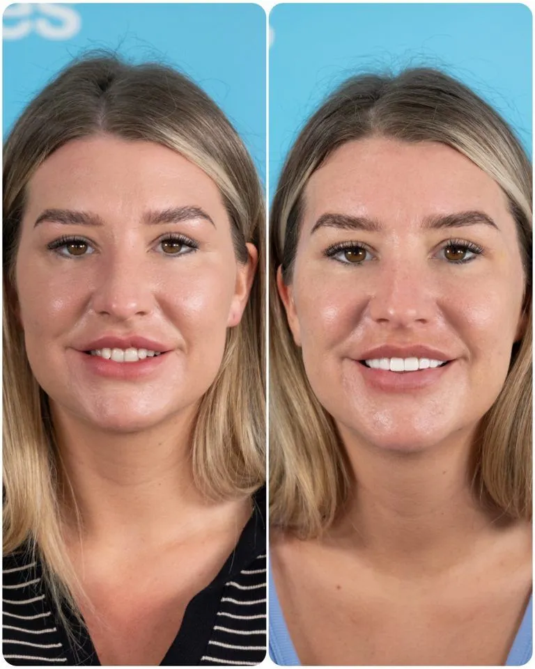 Young woman with shoulder-length hair before and after a natural smile makeover in Turkey