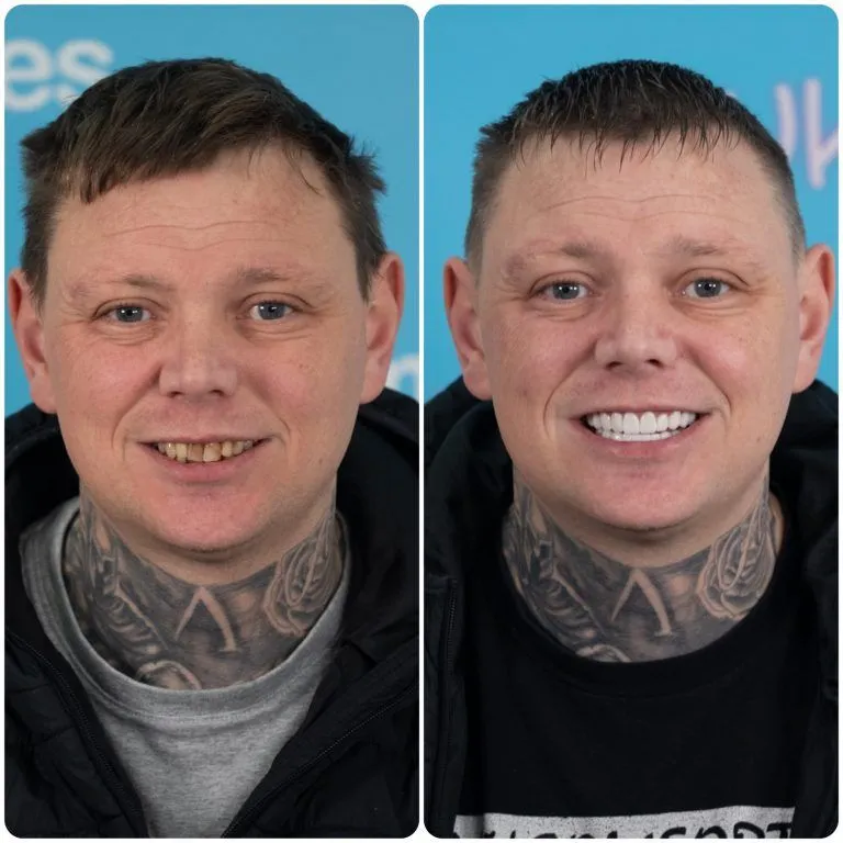 Man with neck tattoos showing worn, discoloured teeth before and a bright new smile after treatment in Turkey