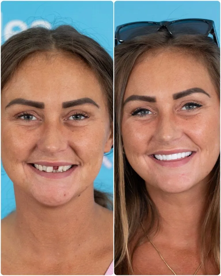 Turkey teeth before and after: a UK Smiles patient with a missing front tooth, then smiling with her new teeth