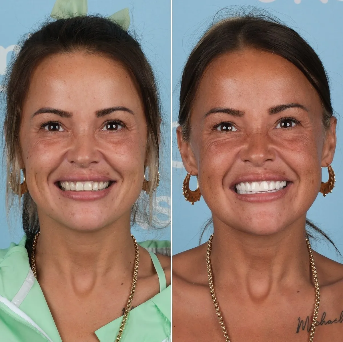Terri before and after zirconia crowns with UK Smiles