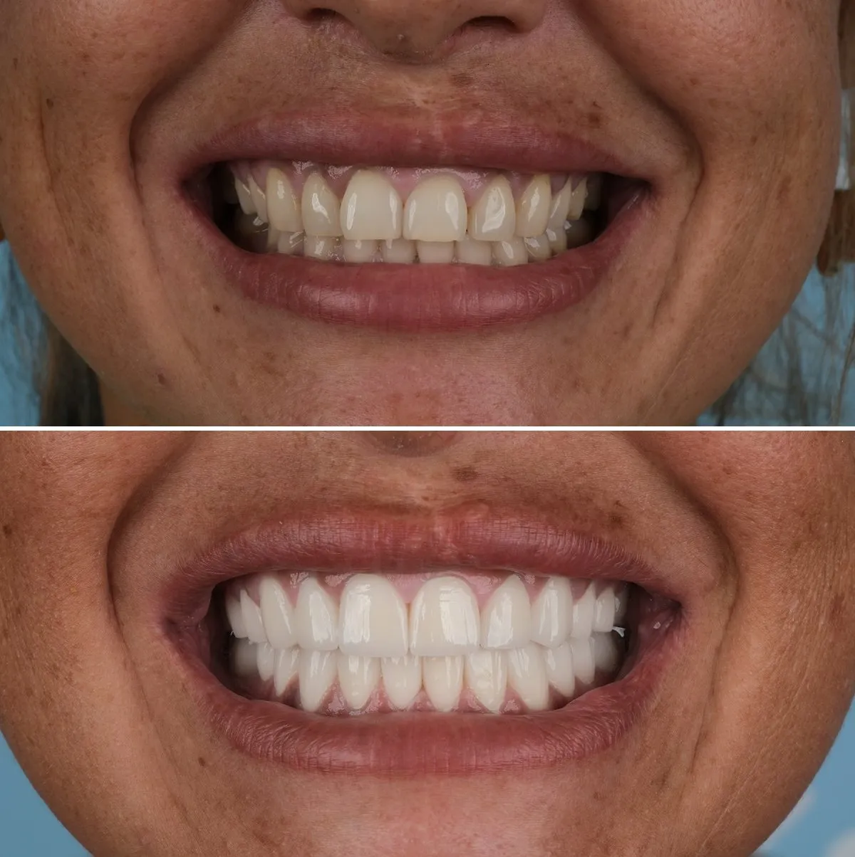 Close-up of Terri's teeth before and after Zirconia Crowns, view 1