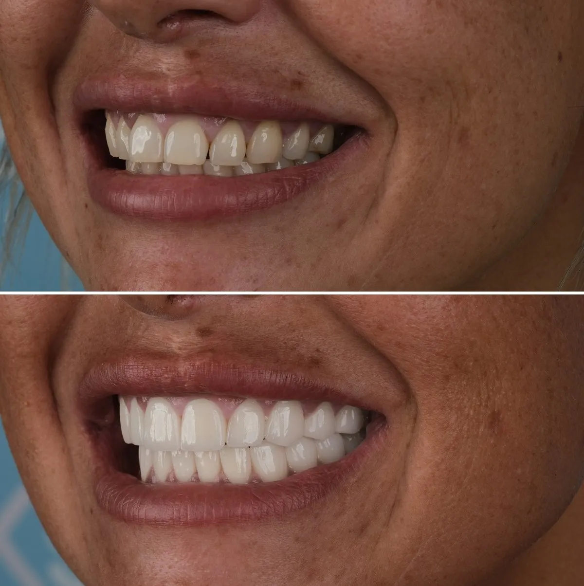Close-up of Terri's teeth before and after Zirconia Crowns, view 2