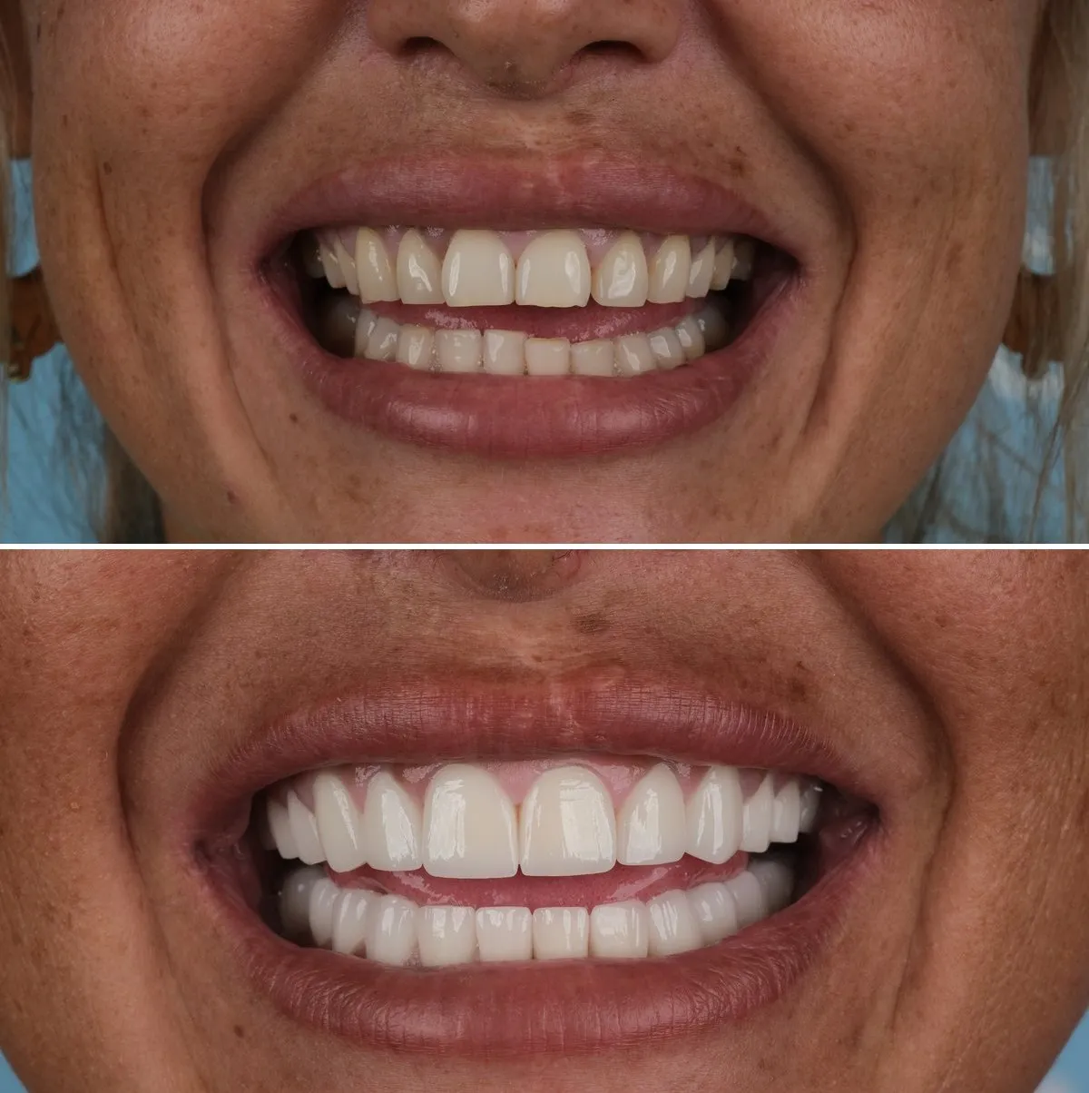 Close-up of Terri's teeth before and after Zirconia Crowns, view 3