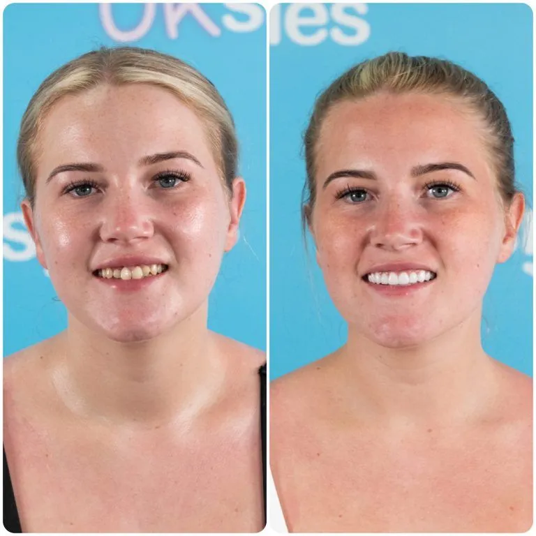 Young blonde woman before and after her new smile at UK Smiles