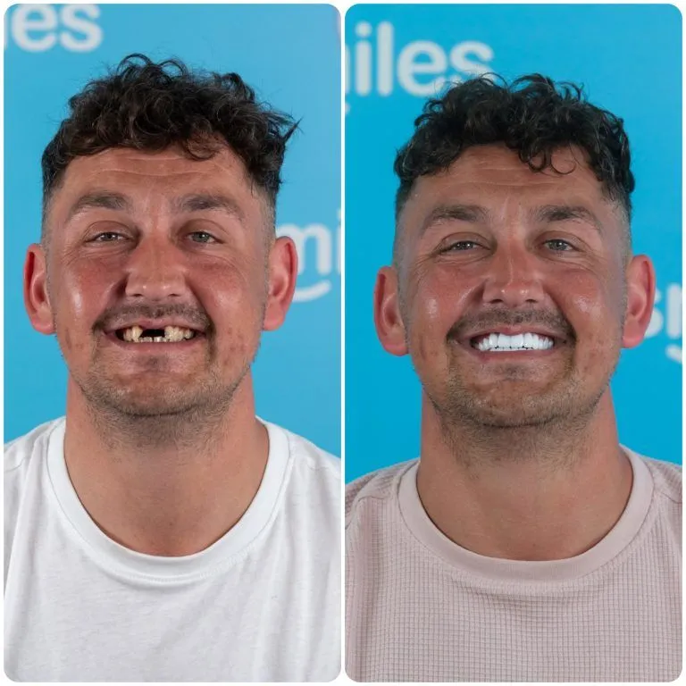 Man with missing front teeth before and a full white smile after treatment in Antalya