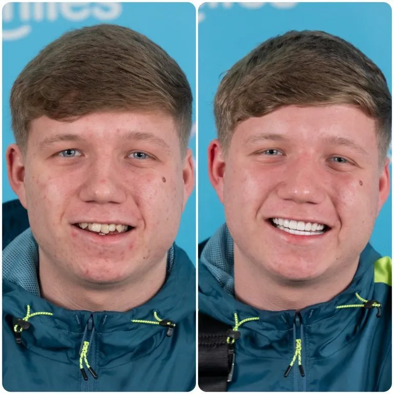 Young man in a rain jacket before and after his new teeth